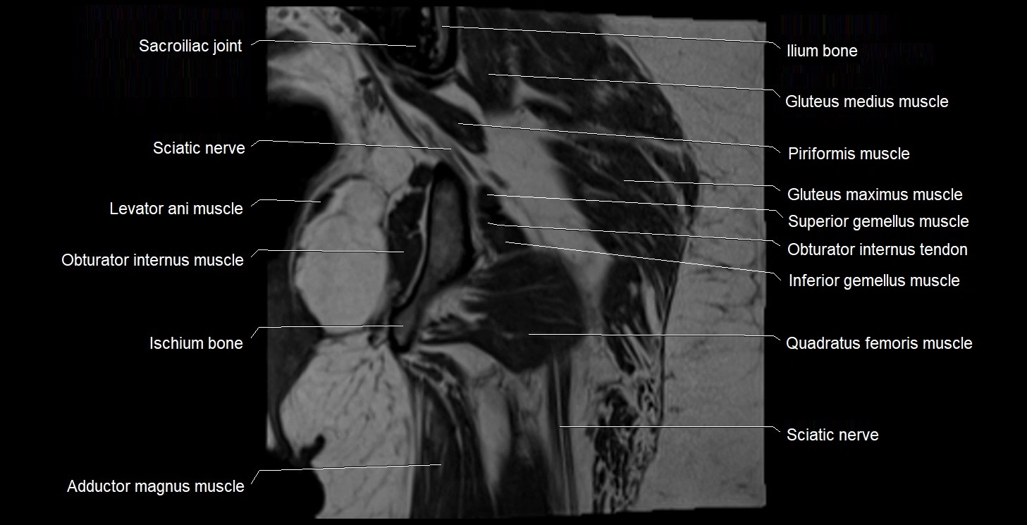 MRI Hip 3T coronal cross sectional anatomy image 47.webp